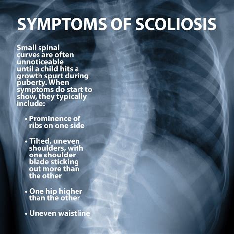 Struggling With Back Pain? You Might Have Scoliosis: Here's What To Look For